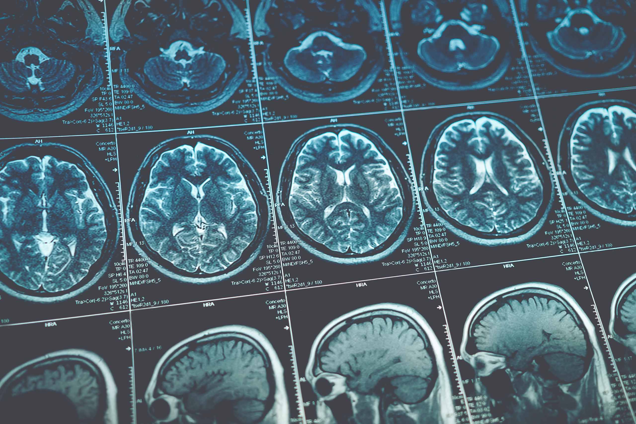 MRI or magnetic resonance image of head and brain scan.