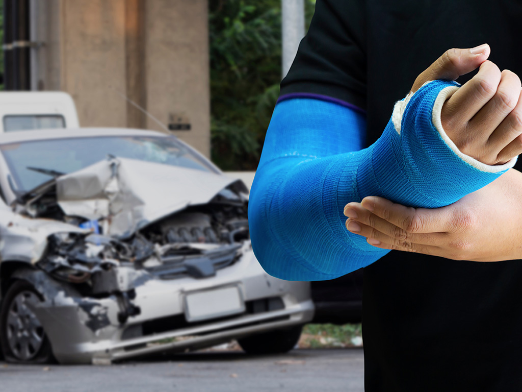 Person wearing a cast after suffering a broken arm in a car accident.