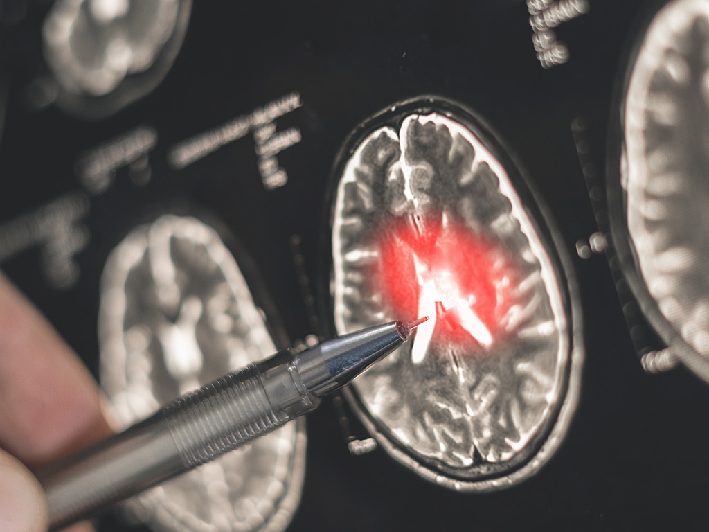 Brain scan highlighting traumatic brain injury caused by a motor vehicle accident.